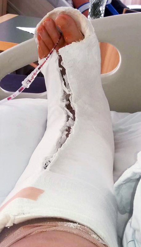 gips1bf.jpg